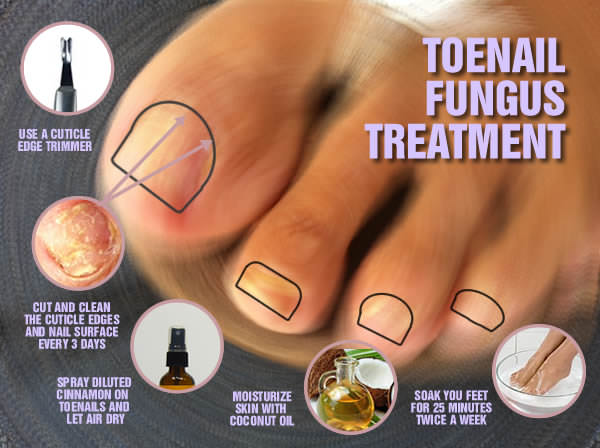 How To Treat Toenail Fungus 