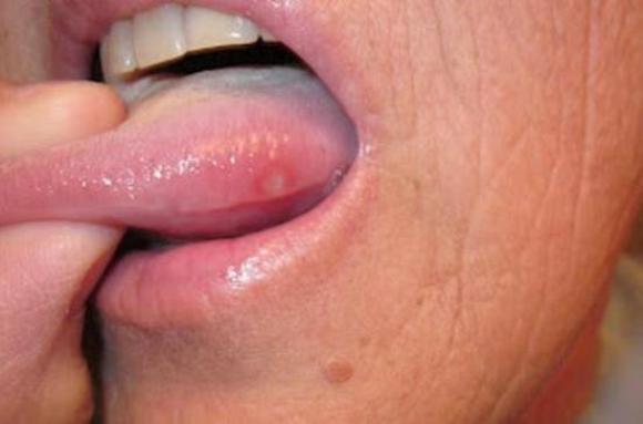 characteristic-remedies-to-treat-blisters-on-the-tongue-at-home-health