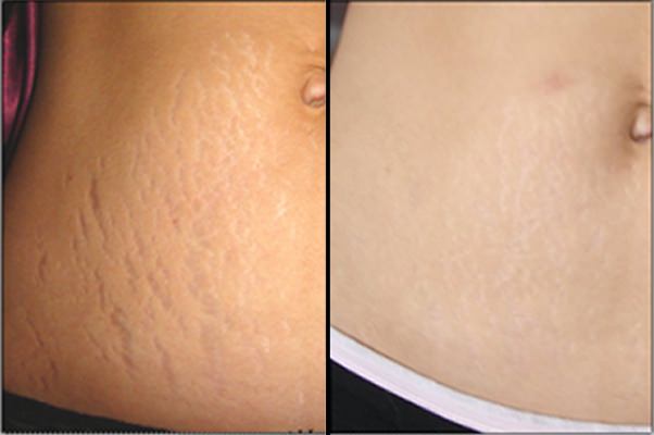 How to Get Rid of Stretch Marks Fast and Naturally?