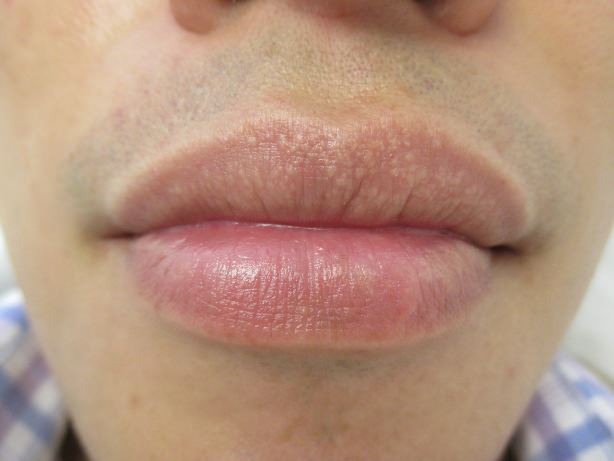 Tips To Prevent And Treat Fordyce Spots On Lips