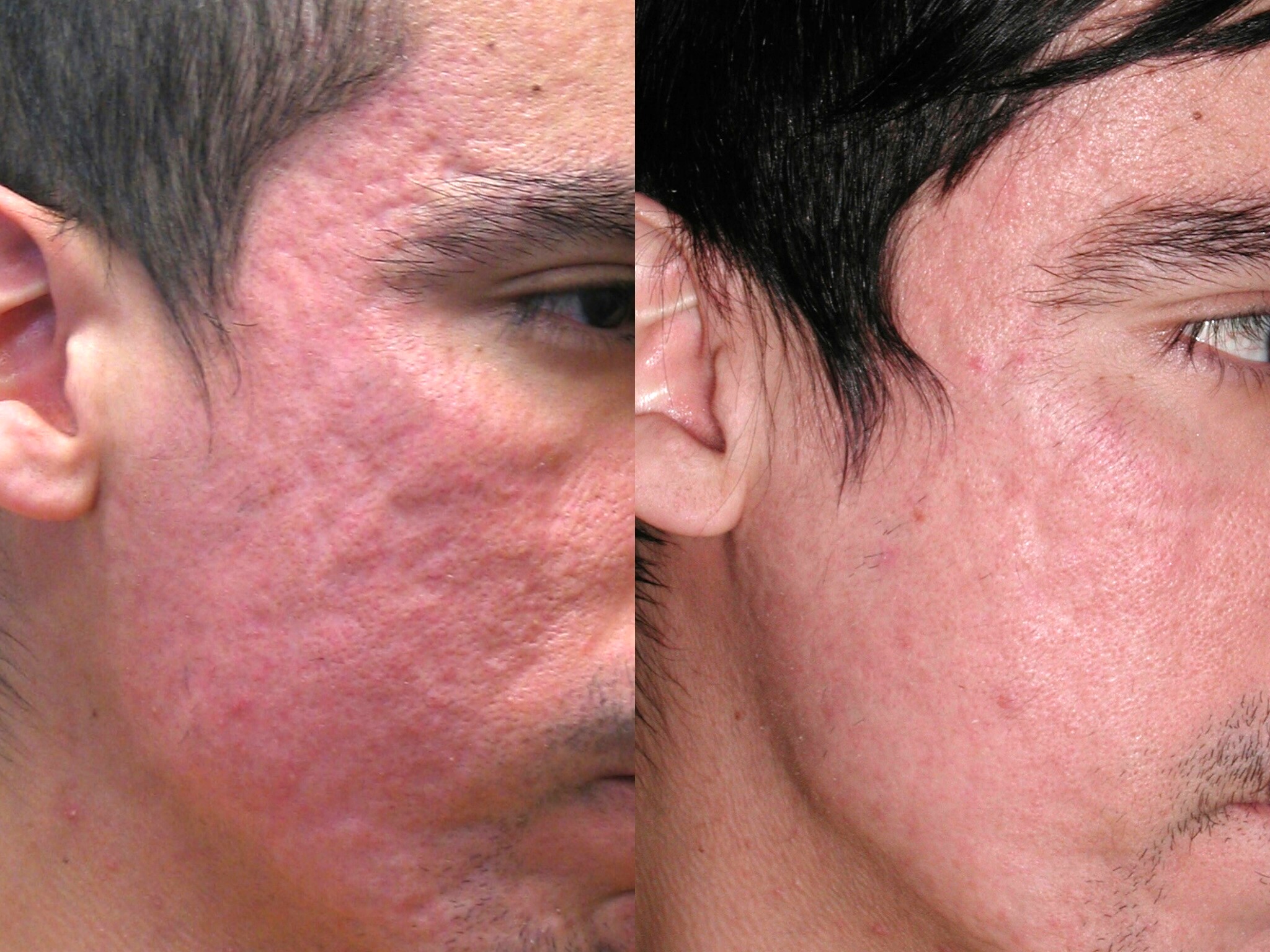 How to Fade Acne Marks?