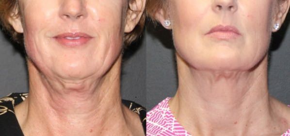How to Tighten Loose Neck Skin?