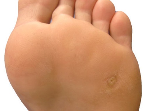 How To Treat A Corn Or Callus 