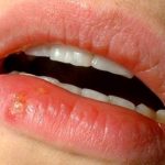 How to Get Rid of Canker Sores Fast