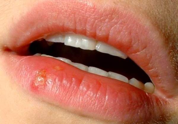 How to Get Rid of Canker Sores Fast
