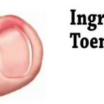 Home remedies for ingrown toenails