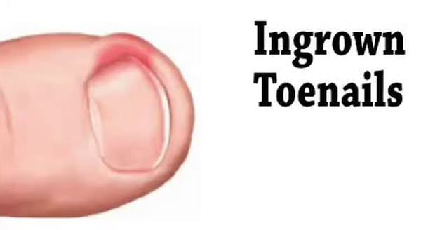 Home remedies for ingrown toenails