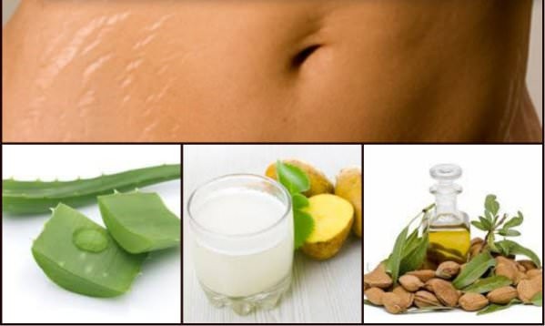 HOME REMEDIES FOR STRETCH MARKS