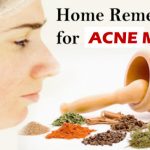 Home Remedies for Acne Marks