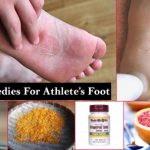 Home Remedies for Athlete’s Foot