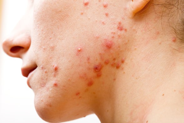 Home Remedies for Cystic Acne