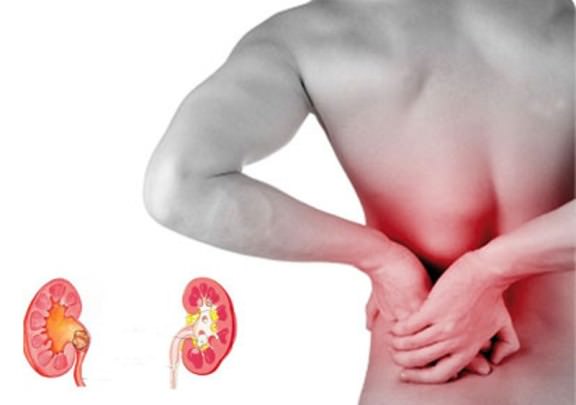 Home Remedies for Gallstones