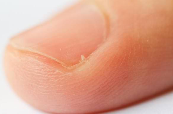 Home Remedies for Hangnails