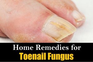 Home Remedies for Toenail Fungus Treatment