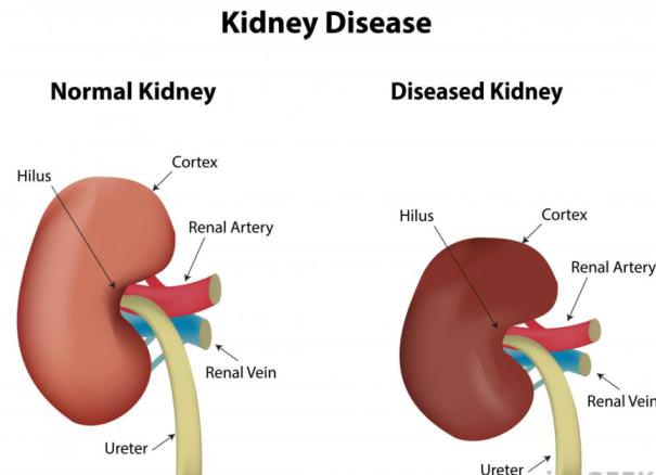 Home Remedies to Reduce High Creatinine Levels