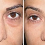 Home remedies for bags under eyes