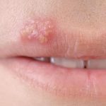 Home remedies for cold sores