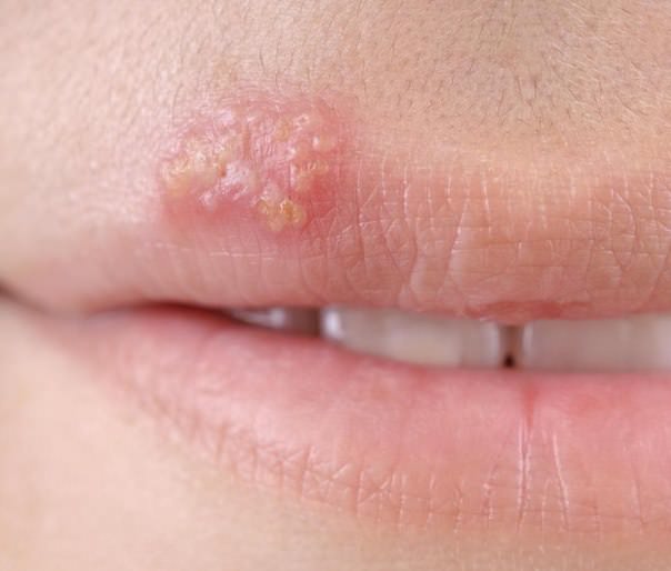 Home remedies for cold sores treatment