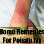 Home remedies for poison ivy