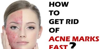 how to get rid of acne marks fast