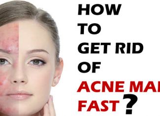 how to get rid of acne marks fast
