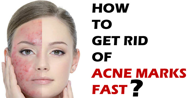 How to Get Rid Of Acne Marks Fast