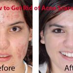 How to Get Rid of Acne Scars Fast