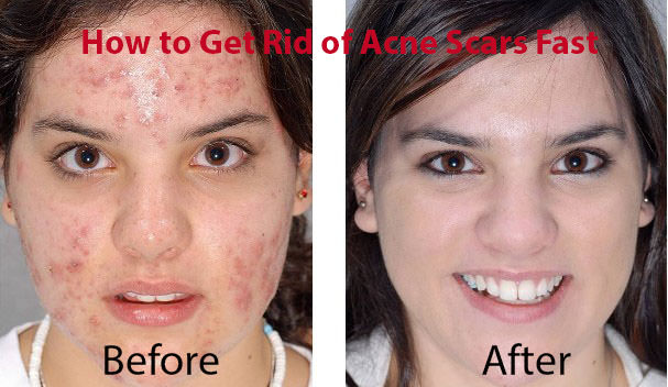 How to Get Rid of Acne Scars Fast