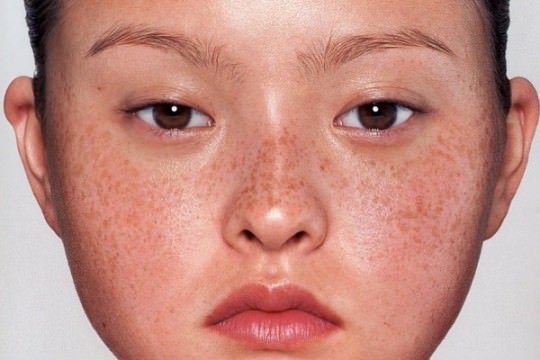 How to Get Rid of Brown Spots on Skin
