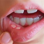 How to Get Rid of Canker Sores in mouth and tongue