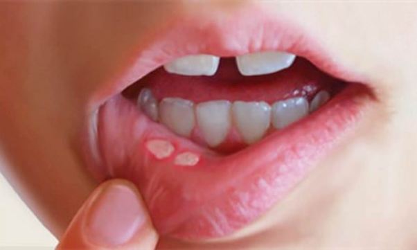 How to Get Rid of Canker Sores in mouth and tongue