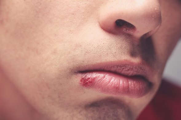 how-to-pop-a-fever-blister-and-other-cold-sore-remedies-the-secret