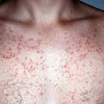 How to Get Rid of Chest Acne?