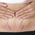 How to Prevent Stretch Marks Avoid Stretch Marks
