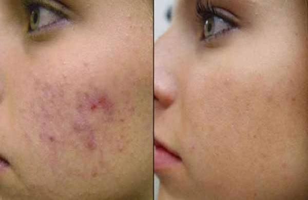 how to reduce pimple redness