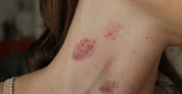 How to get rid of hickey