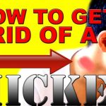 How to get rid of hickey