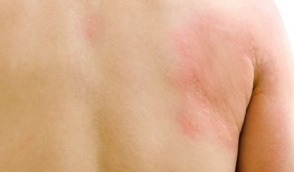 how-to-get-rid-of-hives