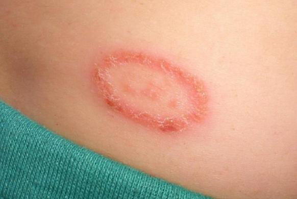 How to get rid of ringworm