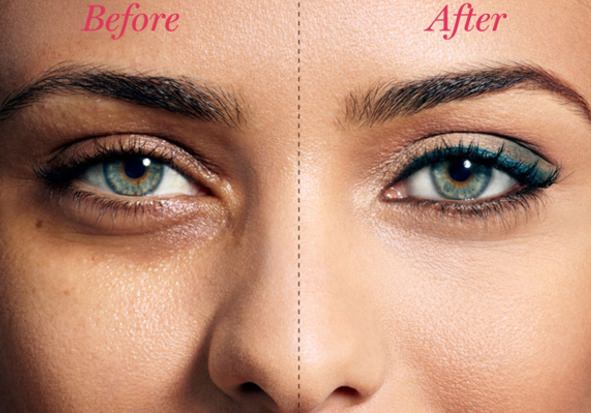 Home remedies for bags under eyes