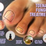 How to treat toenail fungus_mini