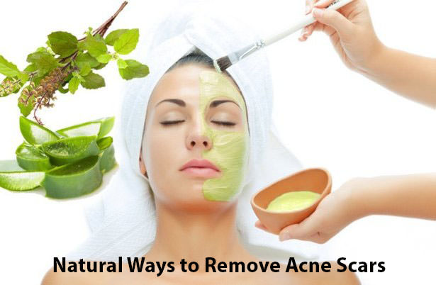Natural Ways to Remove Acne Scars