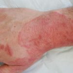 Home Remedies for Fungal Infection