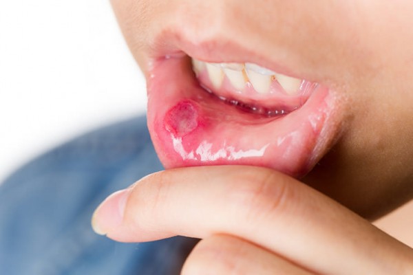 How to Get Rid of Canker Sores fast