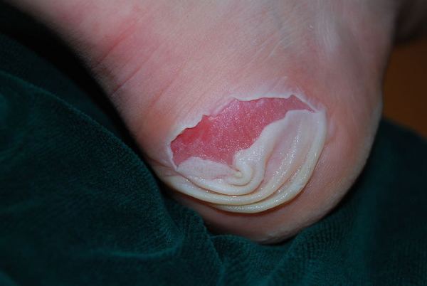 Home Remedies for Foot Blisters