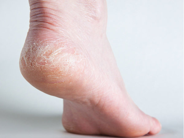 How to Get Rid of Cracked Heels