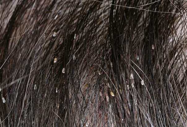 How to Get Rid of Head Lice