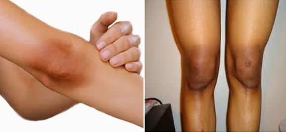 Home Remedies for Dark Elbows and Knees