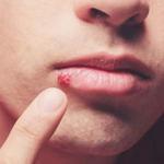 get rid of cold sores overnight