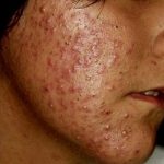 home remedies for acne treatment